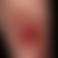 Squamous cell carcinoma of the skin: ulcerated, spinocellular carcinoma of the lower leg, which h...
