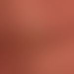 Keratosis areolae mammae acquisita bei einem Patienten mit einer erythrodermischen Psoriasis.
