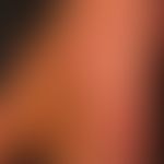 Keratosis palmoplantaris diffusa circumscripta: Thick, waxy, yellowish, plate-like horny layer wh...