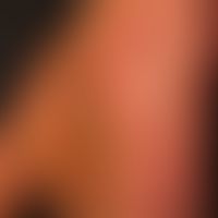 Keratosis palmoplantaris diffusa circumscripta: Thick, waxy, yellowish, plate-like horny layer wh...