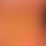 Keratosis palmoplantaris diffusa circumscripta: Thick, waxy, yellowish, plate-like corneal layer,...
