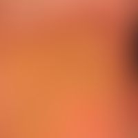 Keratosis palmoplantaris diffusa circumscripta: Dicke, wachsartige, gelbliche, plattenartige Horn...