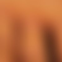 Keratosis palmoplantaris diffusa circumscripta: Detailaufnahme
