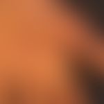 Keratosis palmoplantaris diffusa circumscripta: Thick, waxy, yellowish, plate-like horny layer th...