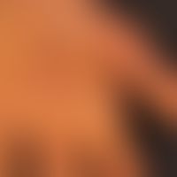 Keratosis palmoplantaris diffusa circumscripta: Dicke, wachsartige, gelbliche, plattenartige Horn...