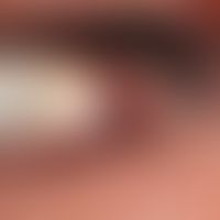 Vaskuläre Malformation vom Typ des Angiokeratoma circumscriptum (Oberlid).
