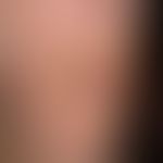 Malum perforans bei Systemamyloidose: areaktives schmerzloses Ulkus an druckbelastetem Areal der ...