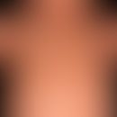 Diffuse kutane Mastozytose, mit gleichförmiger&nbsp;wachsartiger&nbsp;Hautbeschaffenheit und arti...