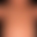 Diffuse cutaneous mastocytosis, with uniform waxy skin texture and artificial blistering, peau-dó...