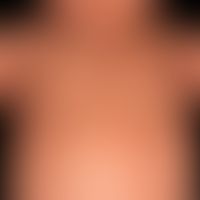 Diffuse kutane Mastozytose, mit gleichförmiger&nbsp;wachsartiger&nbsp;Hautbeschaffenheit und arti...