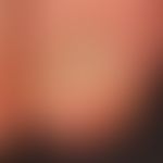 Meesche Querbänder. Ursache unbekannt.
