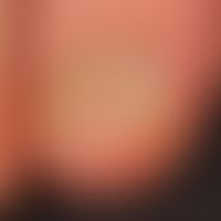 Meesche Querbänder. Ursache unbekannt.
