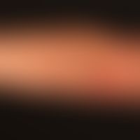 Merkel cell carcinoma: Rapidly growing surface smooth, completely symptom-free lump.
