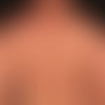 Mycosis fungoides, folliculotropic. 3-year-old clinical picture with strongly itchy, moderately s...