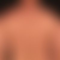 Mycosis fungoides, folliculotropic. 3-year-old clinical picture with strongly itchy, moderately s...