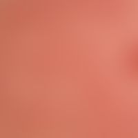 Mycosis fungoides, folliculotropic. 3-year-old clinical picture with strongly itchy, moderately s...