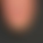 Melanonychia longitudinalis: Wide discrete brown longitudinal discoloration of the thumbnail; the...