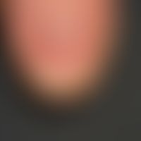 Melanonychia longitudinalis: Wide discrete brown longitudinal discoloration of the thumbnail; the...