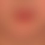 Mycosis fungoides follikulotrope: 10-year-old girl with generalized mycosis fungoides; partial se...