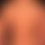 Special form: Mycosis fungoides follikulotrope: 10-year-old girl with generalized folliculotropic...