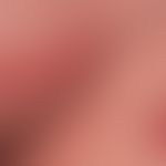 Mycosis fungoides of the "pagetoid reticulosis" type. slight tendency to progression. blander cli...