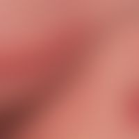 Mycosis fungoides vom Typ der "Pagetoiden Retikulose". Geringe Tendenu zur Progression. Blander k...