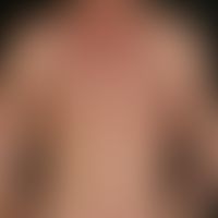 Mycosis fungoides in the plaque stage
