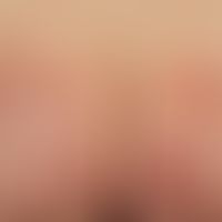 Mycosis fungoides patch stage: For the first time in the 39-year-old woman multiple, itchy, eryth...