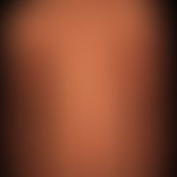 Naevus verrucosus (series): Spontaneous regression of the verrucous nevus after a "banal" febrile...