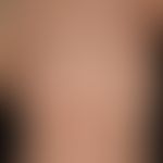 Naevus verrucosus (Serie): Klinisches Bild mit&nbsp;7 Monaten. Ausgangssitatuation.
