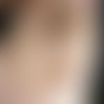 Naevus verrucosus unius lateralis: mit warzenartigen Proliferationen.
