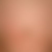 Nevus verrucosus (series): Illustrations in the course of spontaneous regression of the nevus ver...