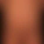 Naevus verrucosus: Abbildungen im Verlauf
