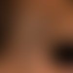 Naevus fuscocoeruleus ophthalmomaxillaris. Unregelmäßig begrenzte, flächenhafte, braune bis schwa...
