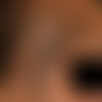 Naevus fuscocoeruleus ophthalmomaxillaris. Unregelmäßig begrenzte, flächenhafte, braune bis schwa...