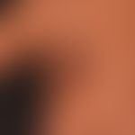 Kongenitaler&nbsp;melanozytärer Naevus. Braune, weiche, scharf zur umgebenden normalen Haut abgeg...