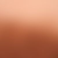 Nevus melanocytic congenital: Incident light micoscopic examination of the margin.
