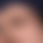 Kongenitaler&nbsp;melanozytärer Naevus. Braune, weiche, scharf zur umgebenden normalen Haut abgeg...