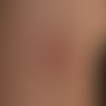Necrobiosis lipoidica: Discrete finding with slightly hardened, ring-shaped plaque and atrophic s...