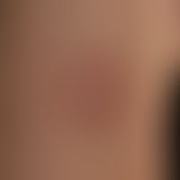Necrobiosis lipoidica: Discrete finding with slightly hardened, ring-shaped plaque and atrophic s...