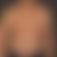 Neurofibromatosis peripheral: Mutiple disseminated neurofibromas
