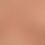 type I neurofibromatosis, peripheral type or classic cutaneous form. detailed view. numerous smal...