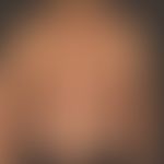 type I neurofibromatosis, peripheral type or classic cutaneous form. numerous smaller and larger ...