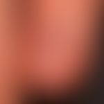 normal fingernail. unchanged shiny nail plate. normally developed epinychium (cuticle). delicate,...