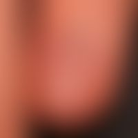 normal fingernail. unchanged shiny nail plate. normally developed epinychium (cuticle). delicate,...
