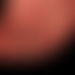 Anonychia in epidermolysis bullosa dystrophica Hallopeau-Siemens
