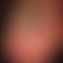 Pincer-nail: Großzehe mit stark gekrümmter und verdickter Nagelplatte.
