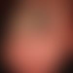 Pincer-nail: Großzehe mit stark gekrümmter und verdickter Nagelplatte.
