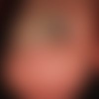 Pincer-nail: Großzehe mit stark gekrümmter und verdickter Nagelplatte.
