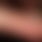 Pincer-Nail:&nbsp; Seitliche Ansicht mit der Zeltdach-artig aufgewölbten Nagelplatte.
